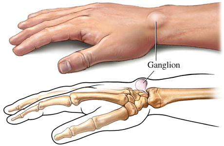 Ganglion Cyst Removal